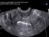 KL v dutine maternice